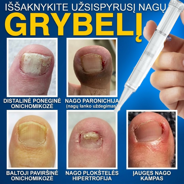 Pažangus priešgrybelinis nagų serumas