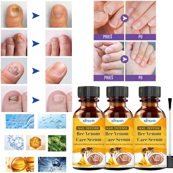 Efektyvi priemonė nagų gydymui bei atstatymui