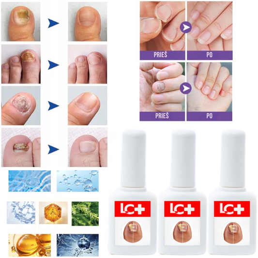 Efektyvi ir itin veiksminga gydomoji priemonė nagų atstatymui