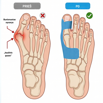 Kineziterapinė juosta hallux valgus korekcijai ir gydymui