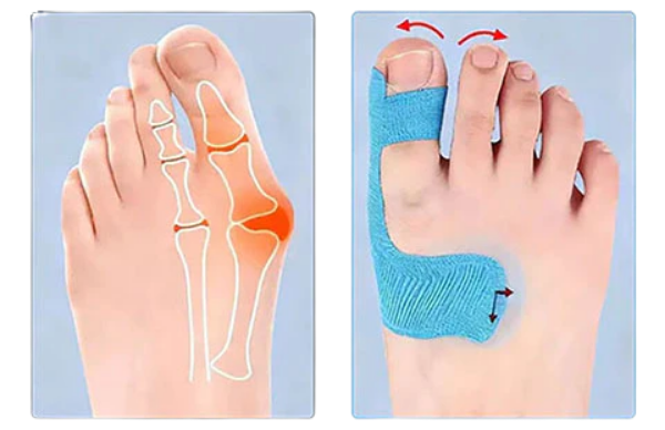Kineziterapinė juosta hallux valgus korekcijai ir gydymui